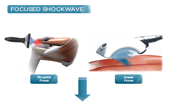 Chiropractic Cumming GA Focused Shockwave